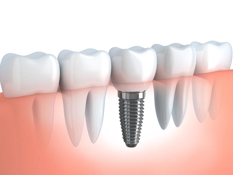 Dental Implants  Brush, CO 
